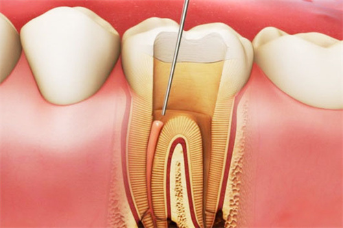 根管治疗牙神经图