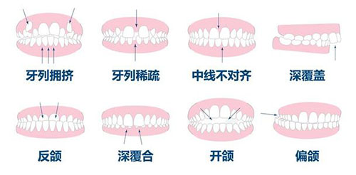 牙齿矫正正畸适应症