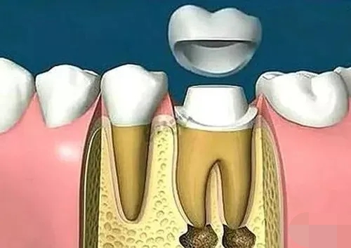 根管治疗后带牙冠