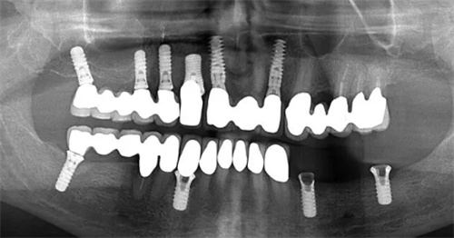 全口种植术后ct