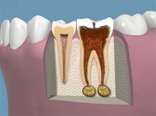 牙齿龋坏根管治疗前