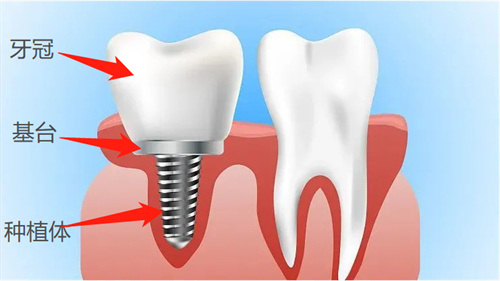 种植牙