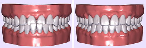 牙齿矫正模拟图前后对比