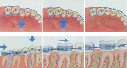 牙齿矫正移动过程示意图