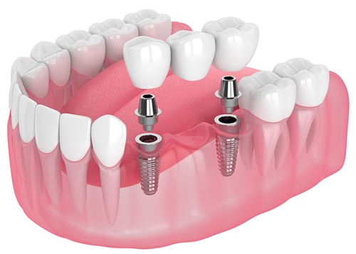 种植牙的构成