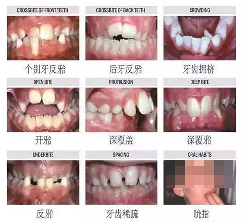 牙齿矫正不同类型的适应症