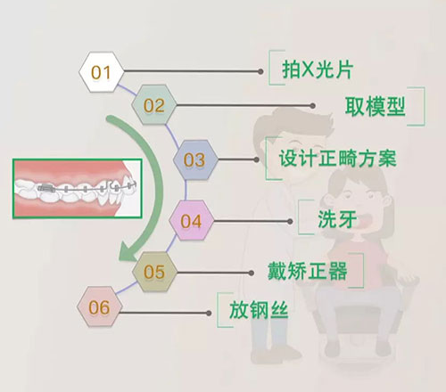 牙齿矫正流程