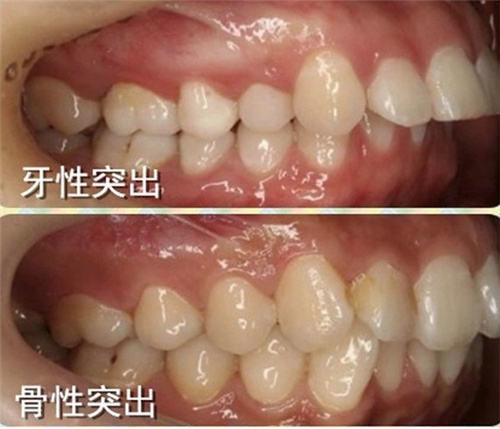 牙性突出跟骨性突出图