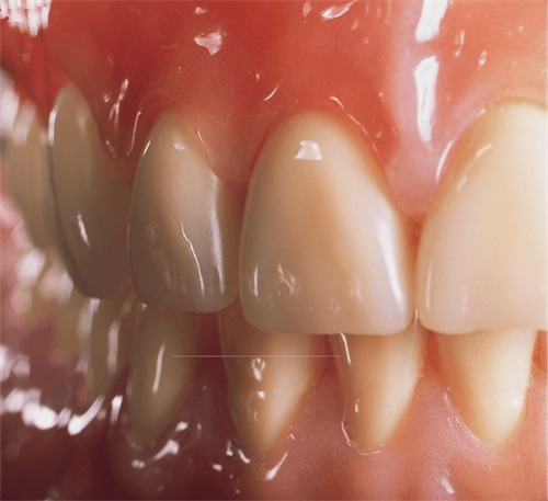 吸附性义齿牙齿细节展示图 吸附性义齿牙齿细节展示图