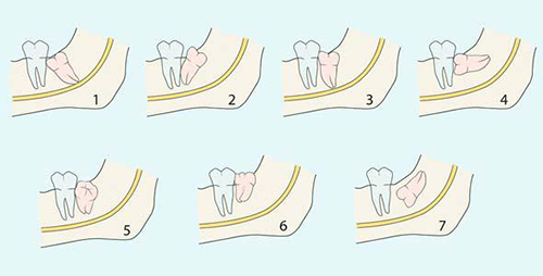 阻生智齿的不同类型