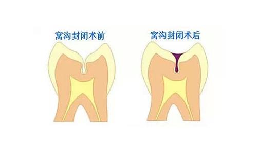 窝沟封闭后的成效