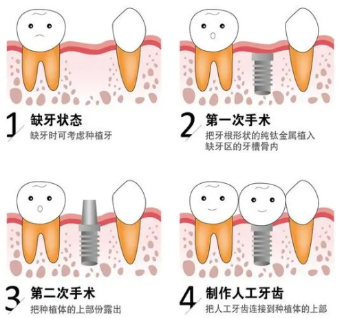 种植牙后的成效