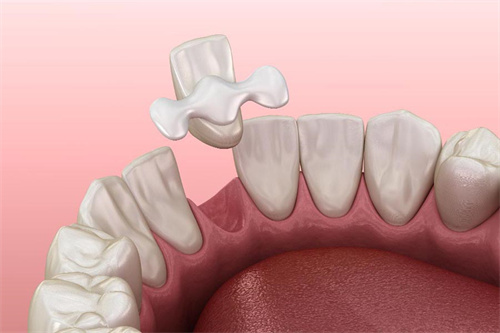 马里兰桥动画 马里兰桥动画