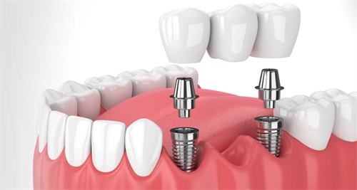 在口腔内进行种植牙
