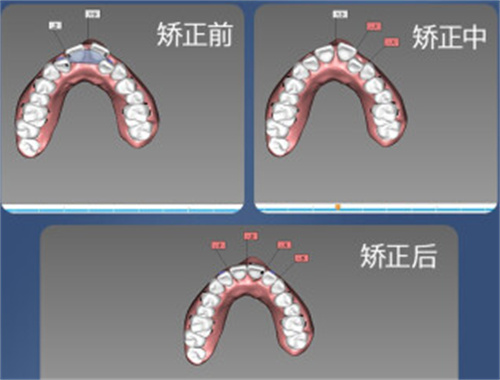 牙齿矫正设计图