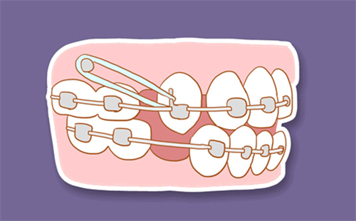 传统金属牙齿矫正