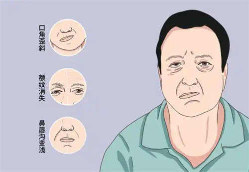 鼓腮漏气症状