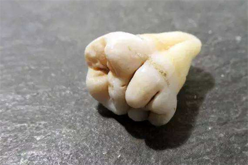 结合牙实物展示图