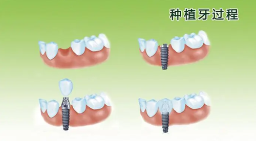 种植牙过程图片