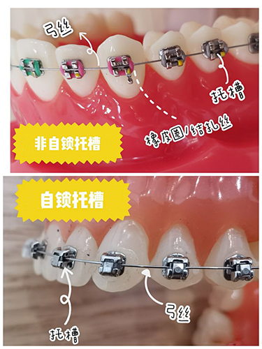 牙齿矫正自锁和非自锁牙套区别
