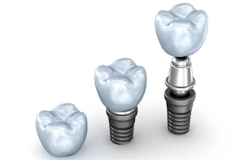 种植牙基台牙冠 种植牙基台牙冠