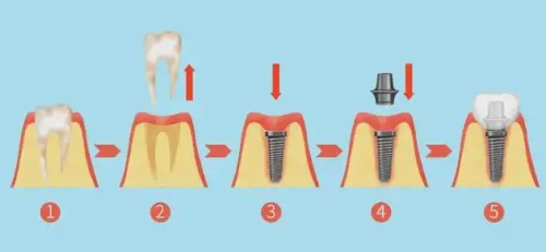 种植牙过程图片 种植牙过程图片