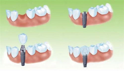 种植牙过程 种植牙过程