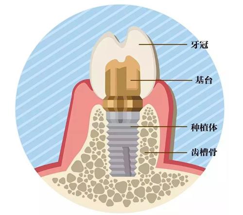 种植牙的组成