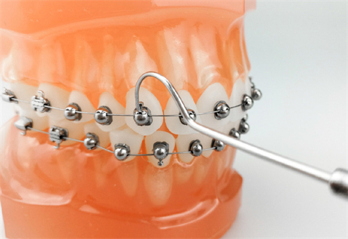 牙齿矫正OBrace球面托槽矫正牙套模型