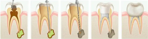 根管治疗步骤图