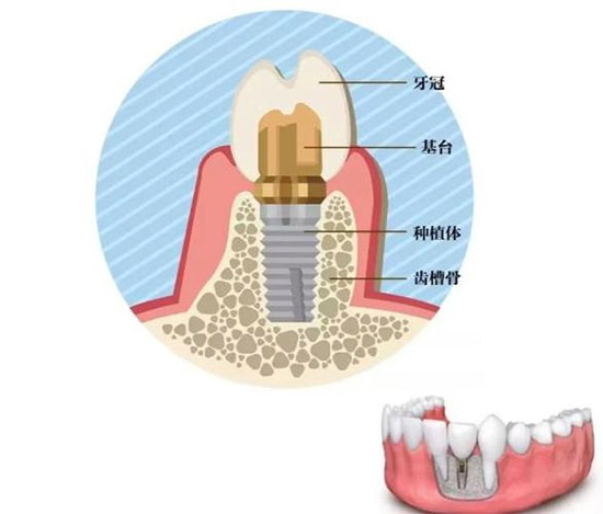 种植牙种类结构图