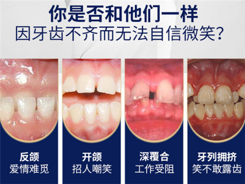 牙齿不齐的几种情况