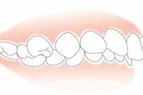 需要牙齿矫正的状态示意图