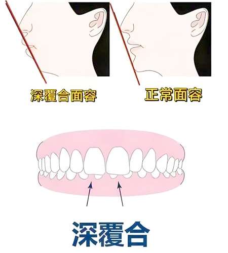 深覆合矫正前后脸型对比图片