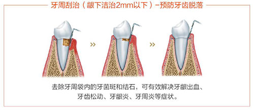 洗牙龈下刮治过程示意图
