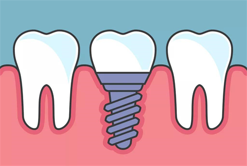 种植牙植入后漫画示意图