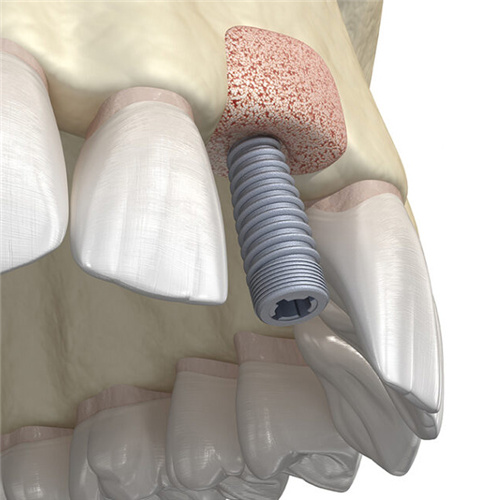 种植牙植骨