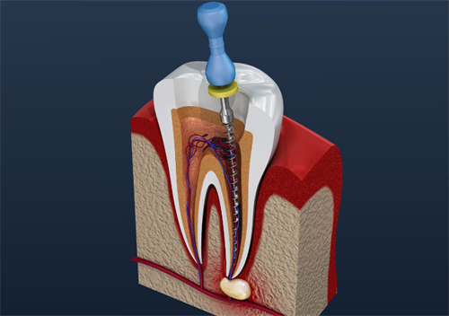 根管治疗中的牙齿