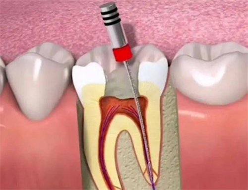 根管治疗过程图解