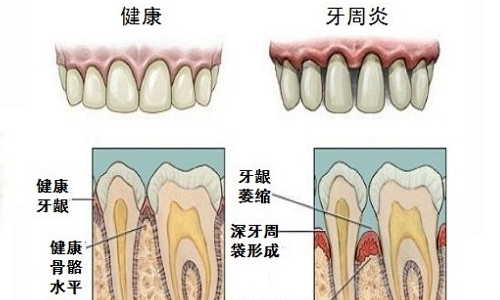 牙周炎情况展示