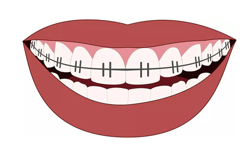 牙齿矫正矫正牙不齐