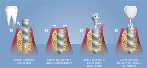 种植牙手术流程图
