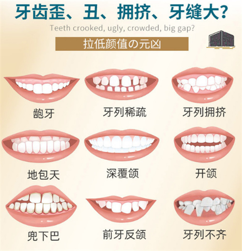 牙齿矫正适应症图示