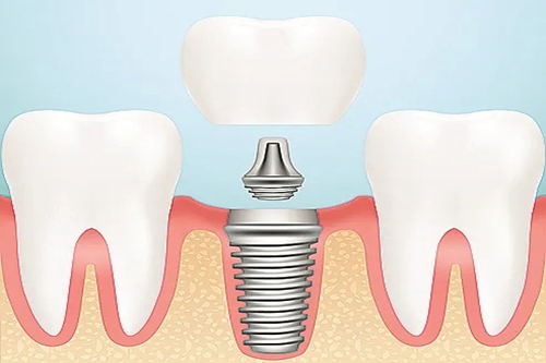 口腔种植牙卡通示意图