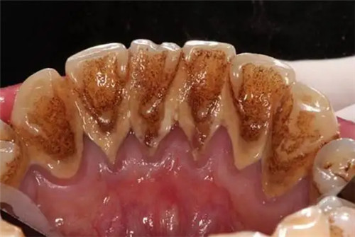 牙结石照片