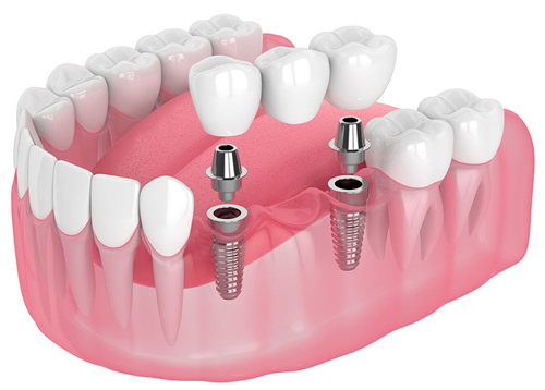 种植牙的构成 种植牙的构成