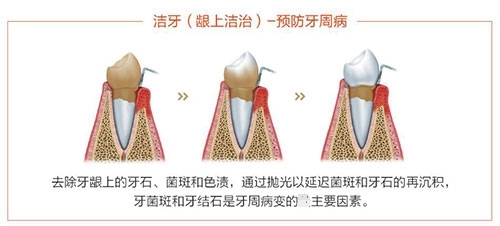 洗牙龈上洁治过程示意图 洗牙龈上洁治过程示意图