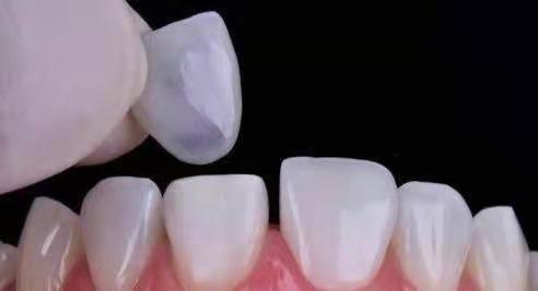 铸瓷材料贴片 铸瓷材料贴片