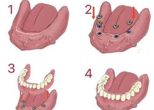 吸附式假牙的原理