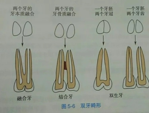 融合牙结合牙双生牙示意图